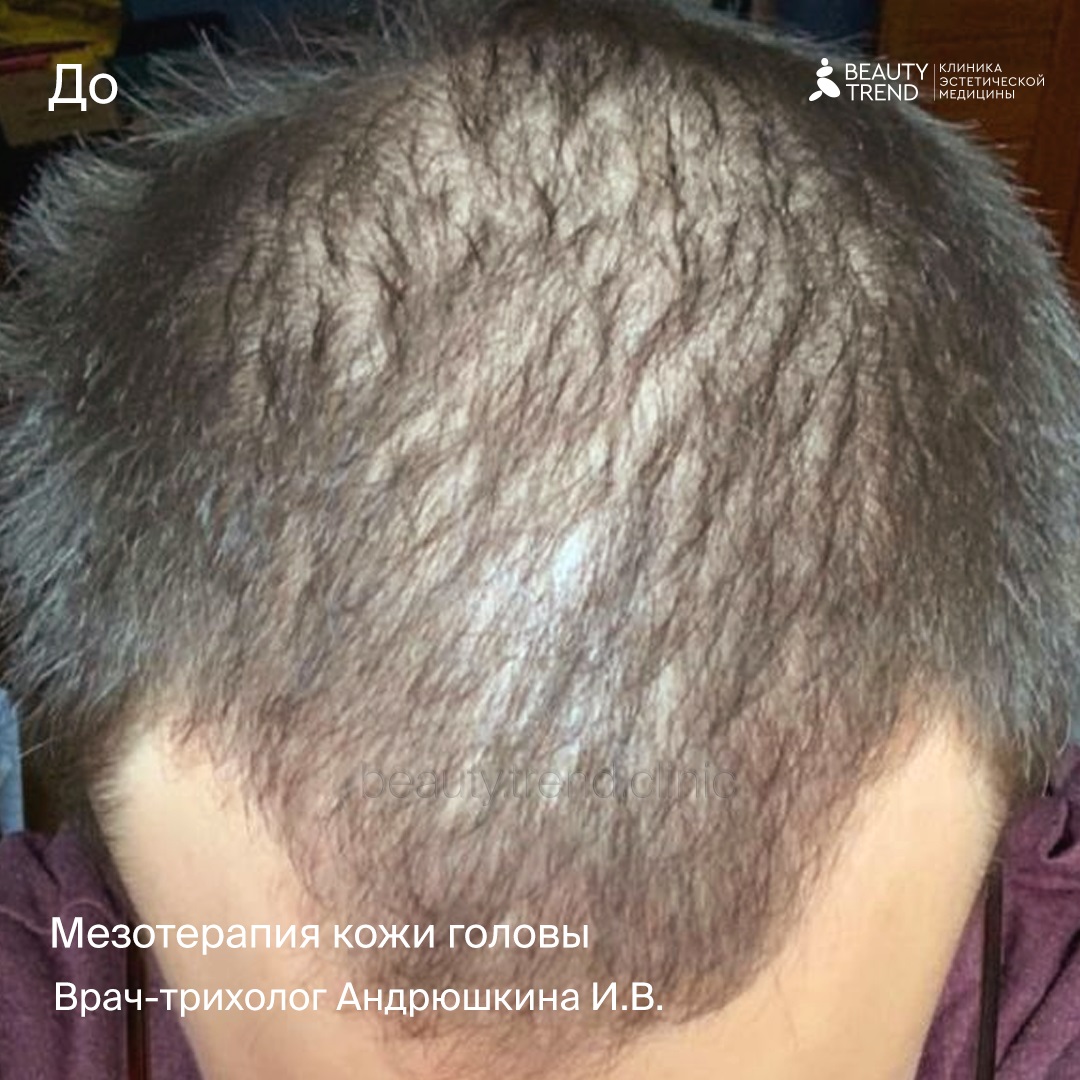 Мезотерапия для укрепления волос, 1А - до 1